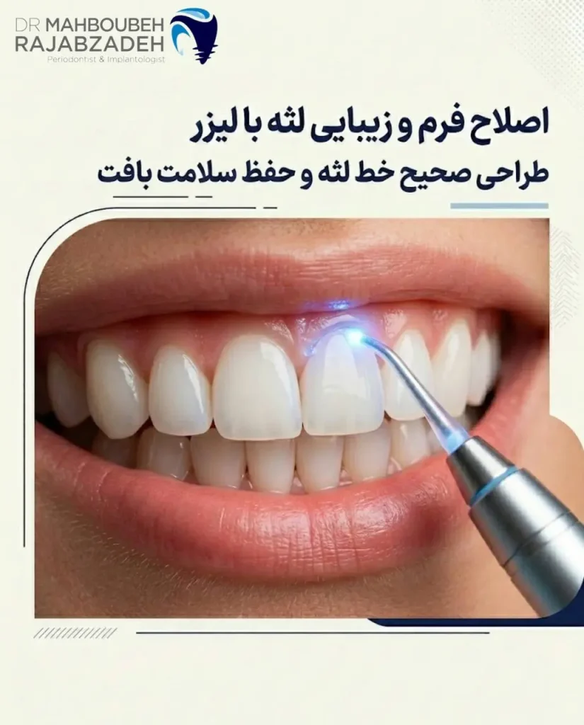لیزر در درمانهای زیبایی لثه چه کاربردی دارد؟